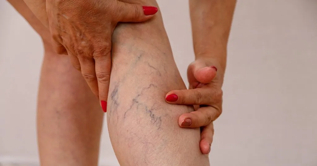 An elderly woman examining her legs for varicose veins