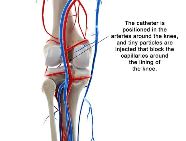 Diagram showing how Geniculate Artery Embolization is performed